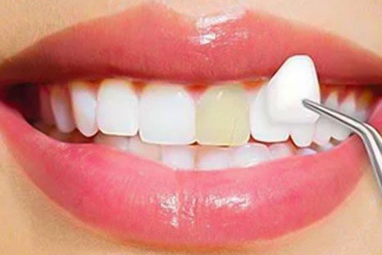 5 Problems That Designer Teeth Veneers Will Eliminate